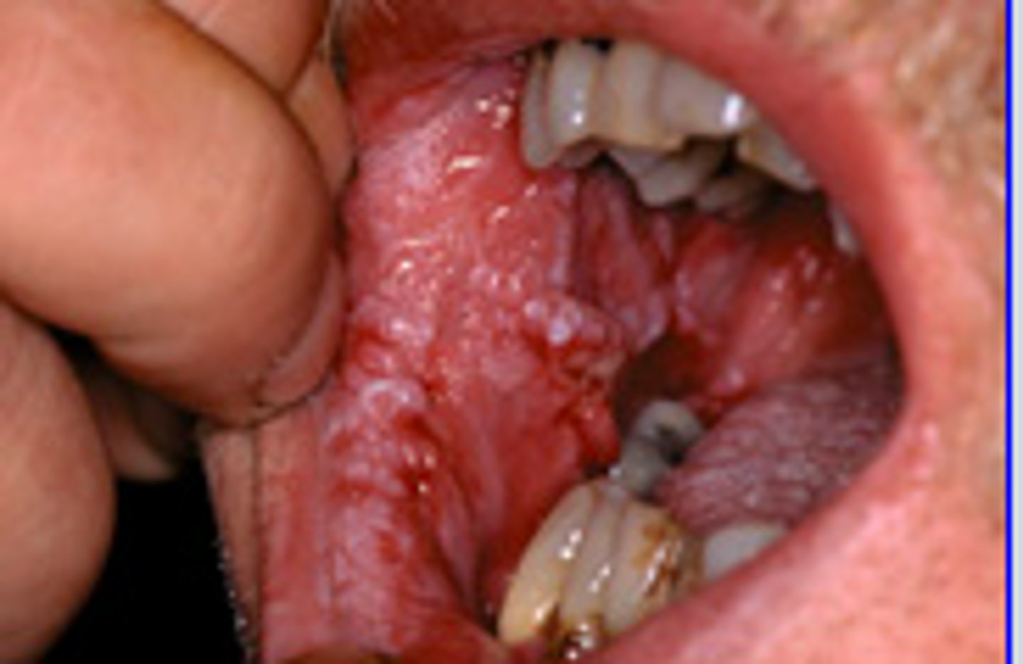 <p>Oral leukoplakia</p><p>- reactive precancerous lesion hyperplasia of squamous epithelium</p><p>- 1 to 20% lesions progressing to squamous carcinoma in 10 years</p>