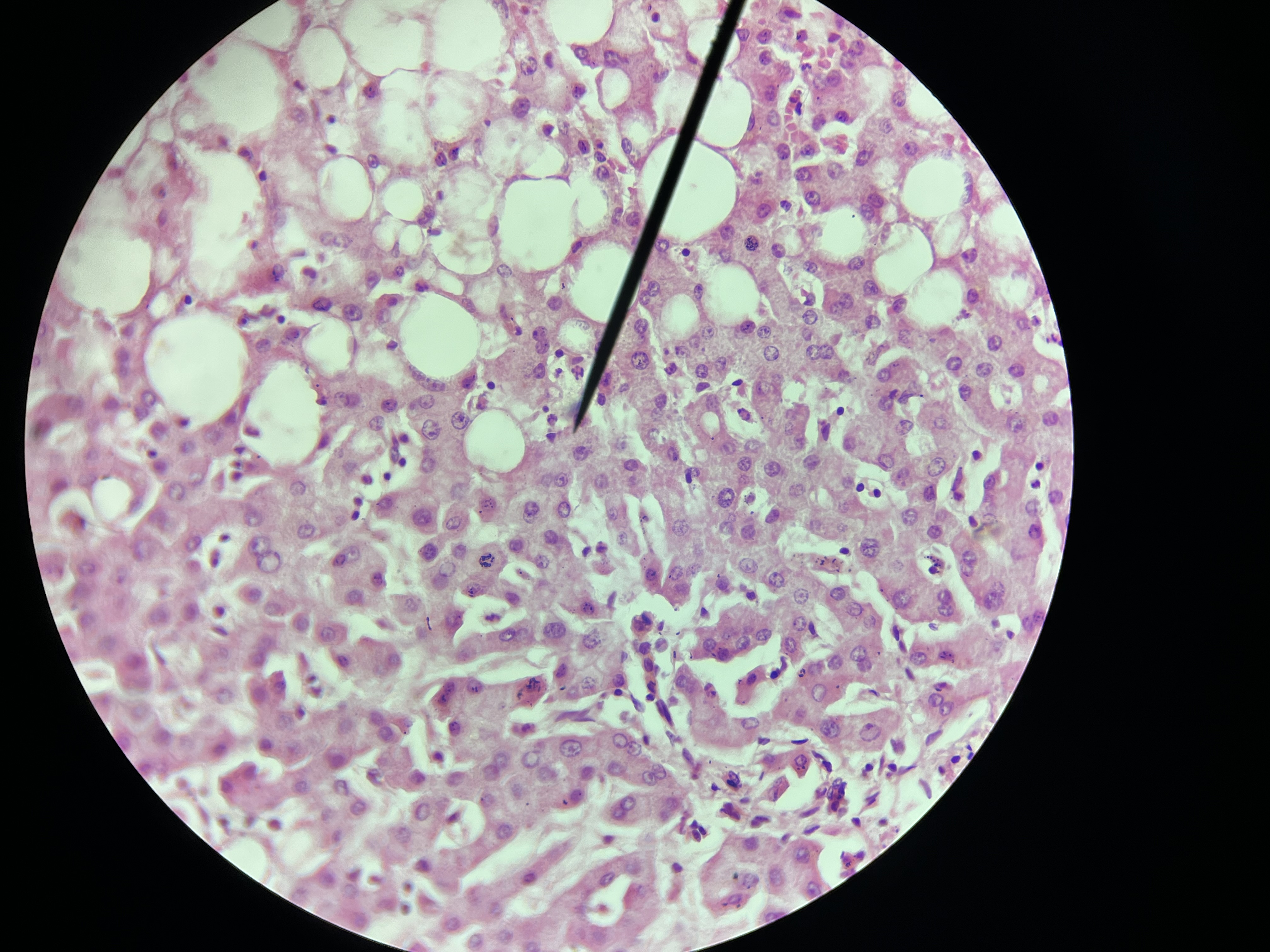 <p><span>Histomorphologic findings include the accumulation of fat within hepatocytes, which can present as macrovesicular or microvesicular steatosis.</span></p>