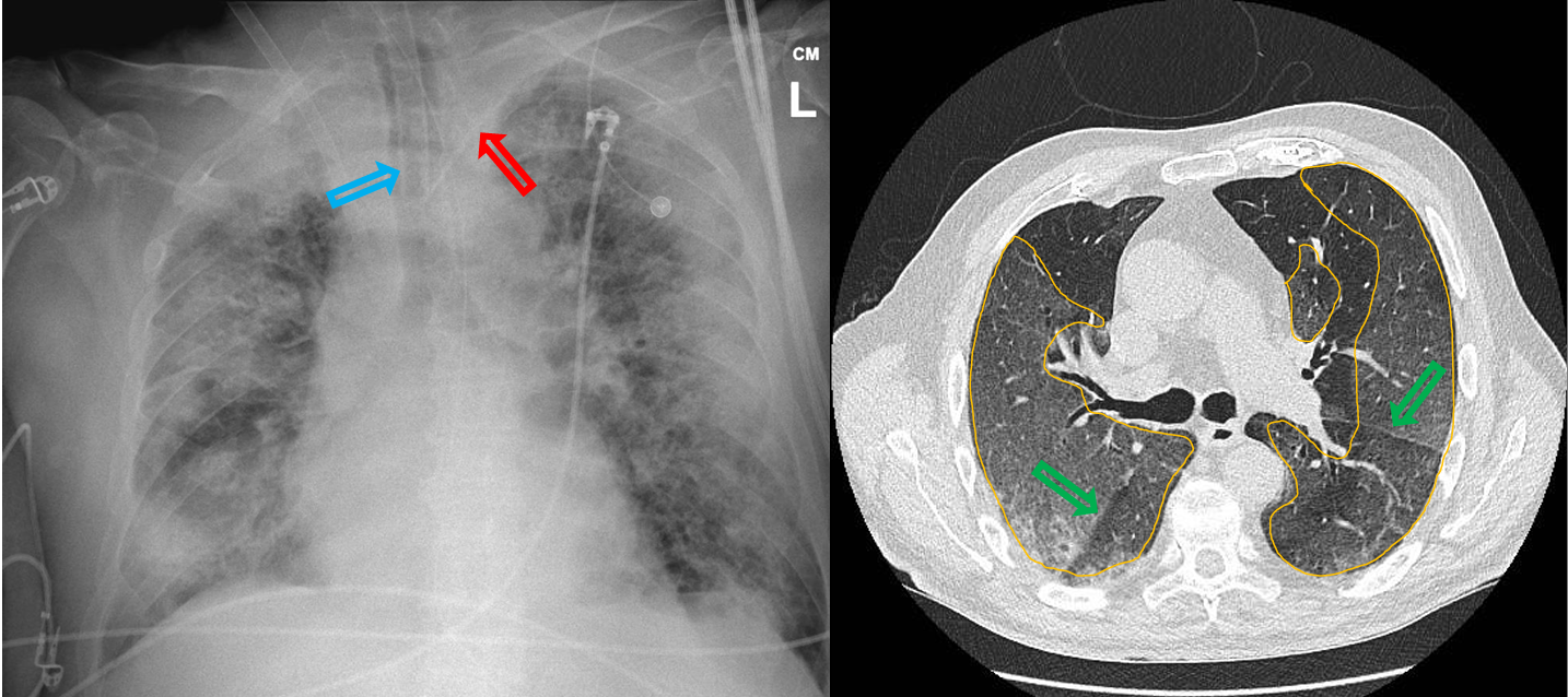 <p>Patient history: acutely developed fever, shortness of breath, cough and fatigue in a 72-year-old patient </p><p>Modality: left– AP prone chest radiograph right–non-enhanced chest CT,axial plane </p><p>Region: chest </p><p>Radiologic sign: peripheral ground-glass opacity in all lung lobes (“ground-glass opacity” – yellow area) and consolidations; oblique fissures (green arrow); foreign bodies: endotracheal tube (blue arrow), ECG electrodes, left v. subclavia catheter (red arrow) </p><p>Diagnosis : Covid 19 pneumonia involving more than 80% of the lung parenchyma, CO-RADS 5</p>