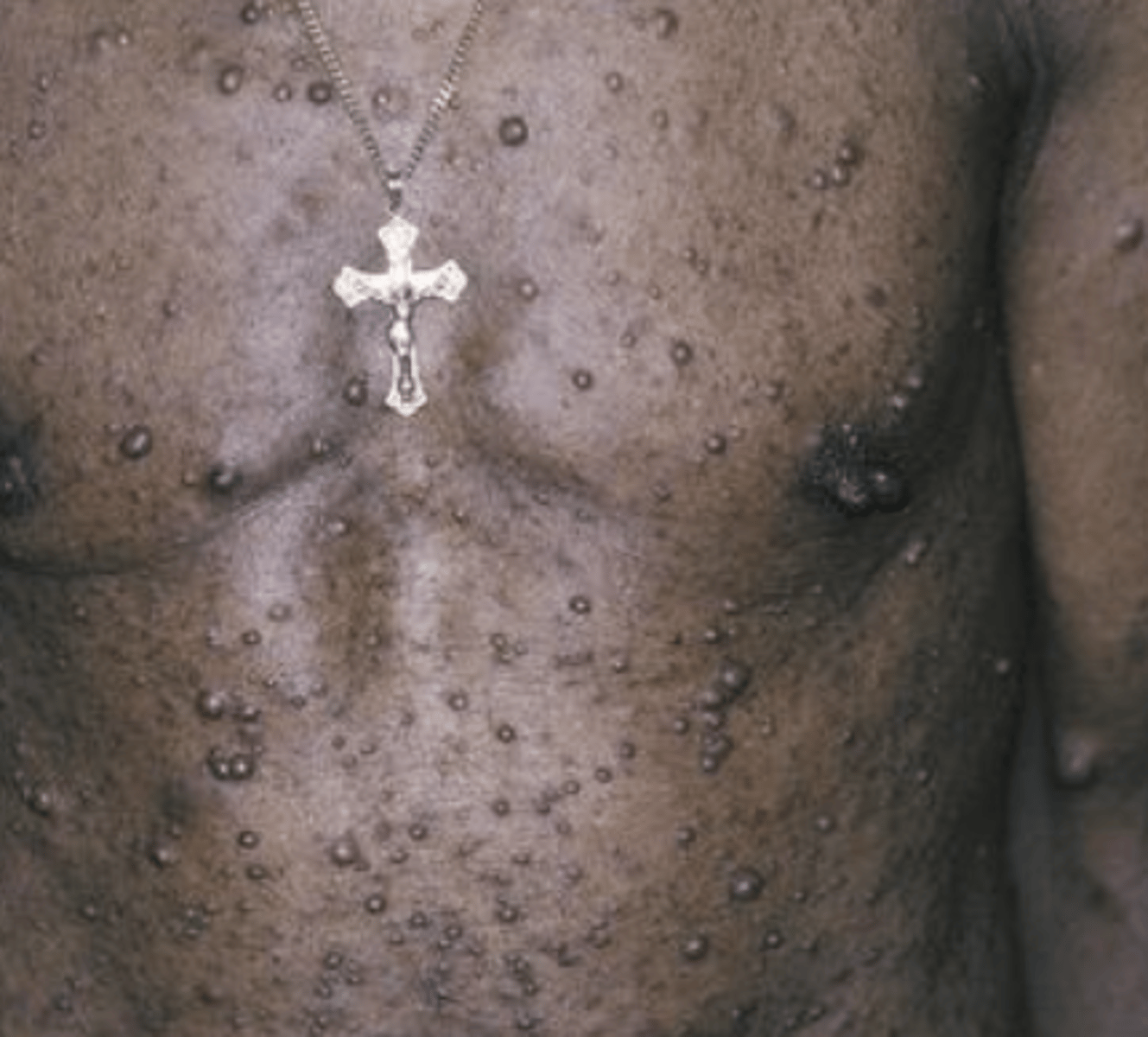 <p>Multiple fibromas on the body</p><p>Cafe au lait pigmentation</p><p>Axillary freckling</p><p>Lisch nodules</p><p>Neurofibromas occur at a young age</p>