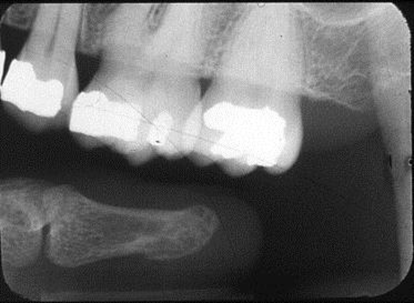 <p>Appearance-The patient's finger appears on the plate</p><p>Cause-The patient's finger was positioned in front of the plate</p><p>Correction-Make certain the patient's finger is placed behind the plate (if necessary)</p>