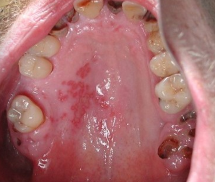 <p>Case 12. A 66-year-old male developed these lesions following the flu. 12a. What is the most likely differential diagnosis?</p>