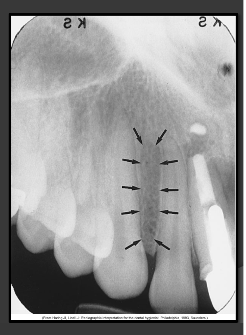 <p>It is a radiolucency that appears in the bone that can surround the canine, lateral, and central.</p>