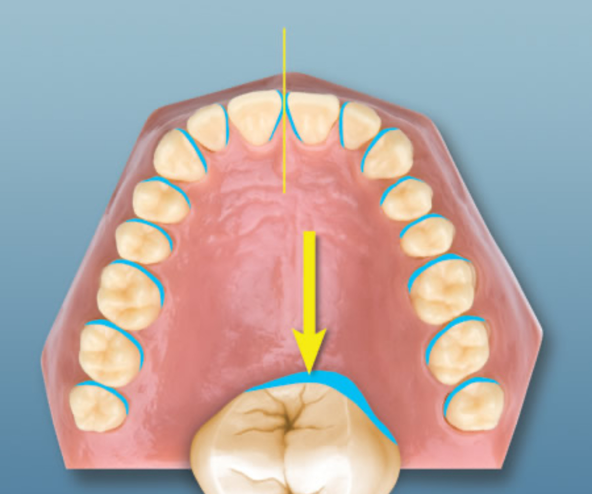 <p>The surface of the tooth toward the midline.</p>