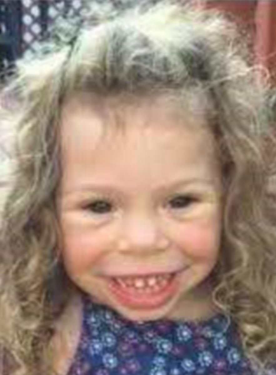 <p>mutation or deletion of the elastin gene at 7q11.23</p><p>CHARACTERIZED BY:</p><p>- hypersocialability</p><p>- mild neurologic dysfunction</p><p>- hypotonia</p><p>- cerebellar dysfunction</p><p>- facial abnormalities</p><p>- slow growth</p><p>- connective tissue abnormalities</p><p>- scoliosis/kyphosis</p><p>- aortic stenosis</p><p>- hypertension</p><p>- mitral valve prolapse</p>