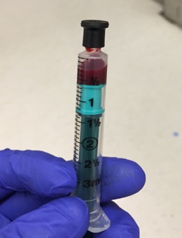 <ul><li><p><mark data-color="yellow" style="background-color: yellow; color: inherit;">Specimen should arrive to the lab in a sealed heparinized syringe as shown in the image below.</mark></p></li><li><p>Traditionally specimen must be placed in ice slurry immediately (not frozen)</p></li><li><p>If the test is performed within 15 minutes, ice may not be required. </p><ul><li><p>It is important to follow the lab’s SOP (standard operating procedure).</p></li></ul></li><li><p>As per recent guidelines</p><ul><li><p>if a plastic syringe is used, it should be kept at room temperature and not on ice slurry. </p></li><li><p>If glass syringe is used, it can be kept on ice slurry.</p><p></p></li></ul></li></ul><p></p>
