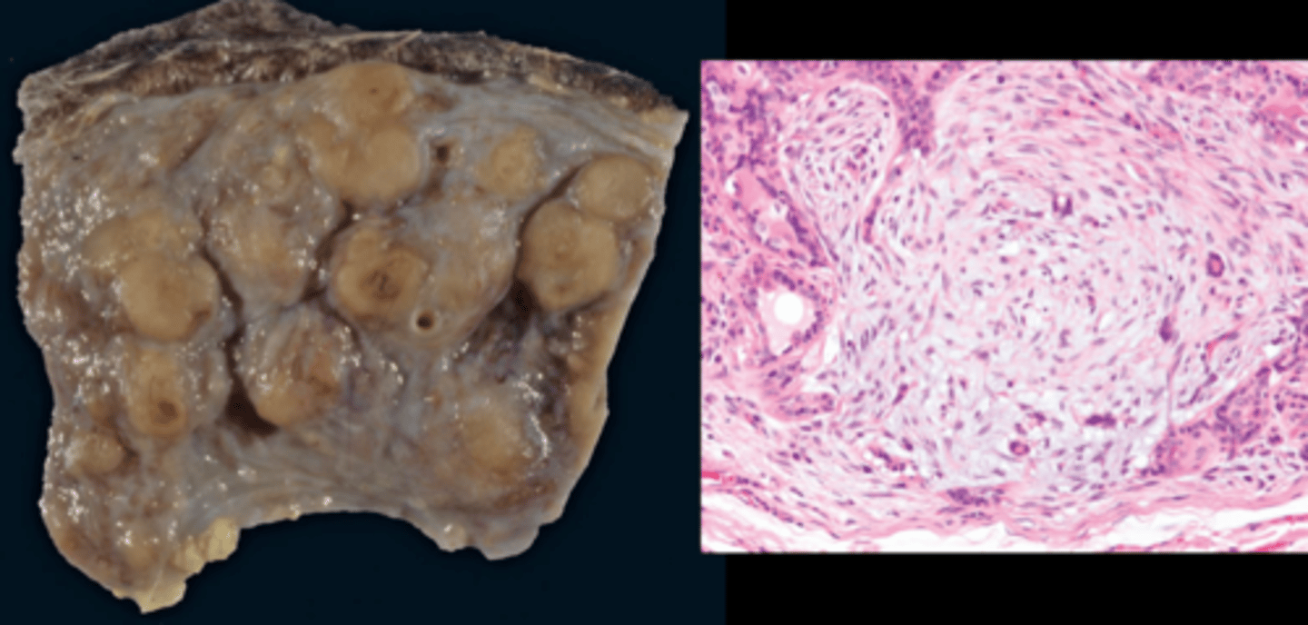 <ul><li><p> more than half of mammary masses, often have epithelial (adenoma) and mixed myoepithelial/mesenchymal component (complex mammary adenoma with epithelial and myoepithelial components).</p></li></ul><p></p>