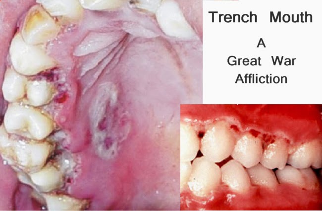 <p>b) Acute necrotizing ulcerative gingivitis (ANUG) and chronic periodontitis</p><div data-type="horizontalRule"><hr></div><ul><li><p>Periodontitis</p></li><li><p>Vincent’s disease (Trench mouth/Necrotizing Ulcerative Gingivitis)</p><ul><li><p>Presence of painful punched-out grayish pseduomembrance in the gingiva; fetid odor</p></li></ul></li></ul><div data-type="horizontalRule"><hr></div><p>Treatment:</p><ul><li><p>Debridement - removal of damage tissue</p></li><li><p>Irrigation</p></li><li><p>Antibiotics (penicillins)</p></li></ul><p></p>