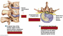a rupture of the nucleus pulpous through the annular wall of the disc and into the spinal canal