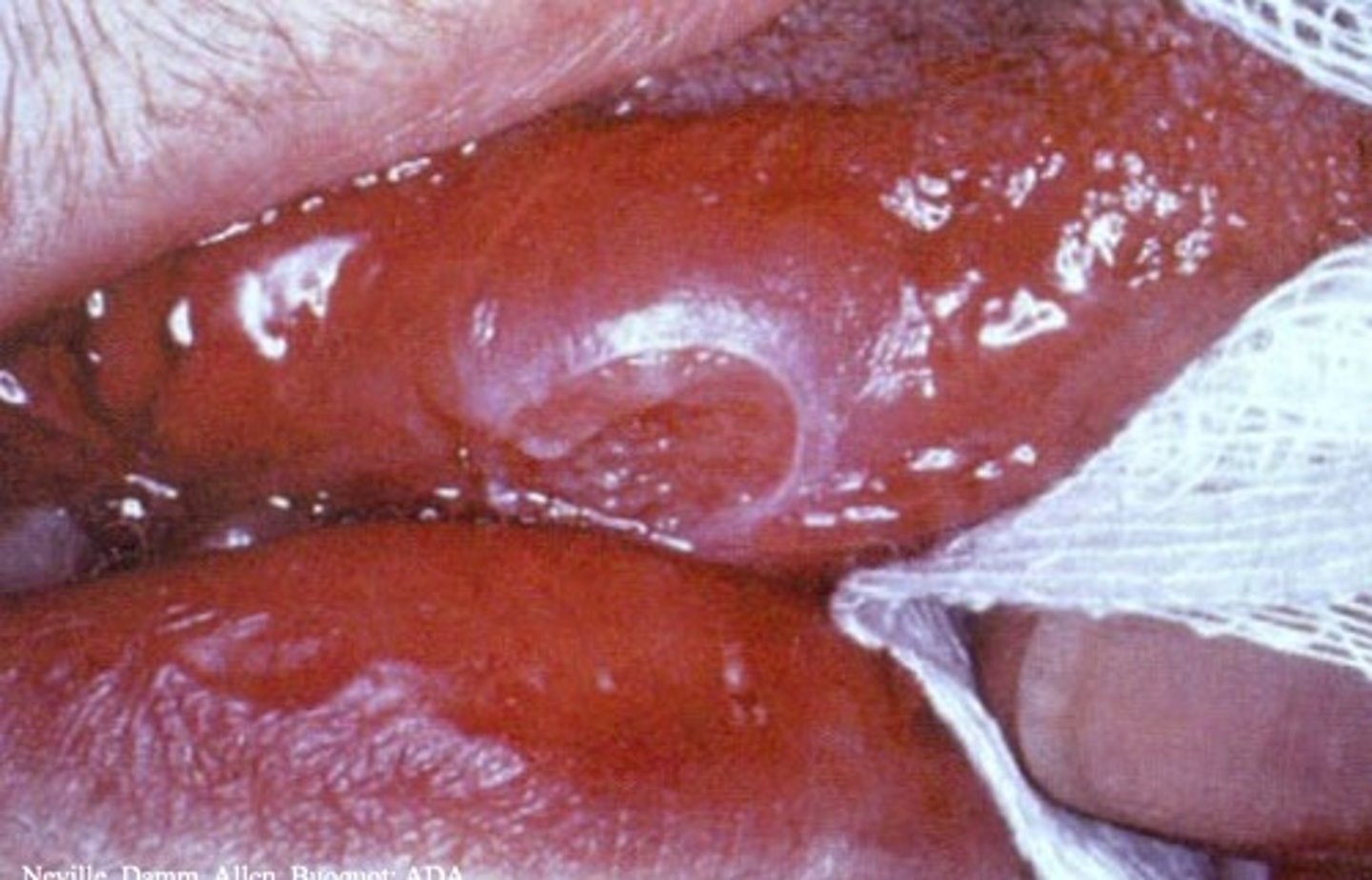 <p>single chronic ulcer</p><p>• common locations: tongue, gingiva, palate</p><p>• Mycobacterium tuberculosis </p><p>• EX: Scrofula (neck)</p>