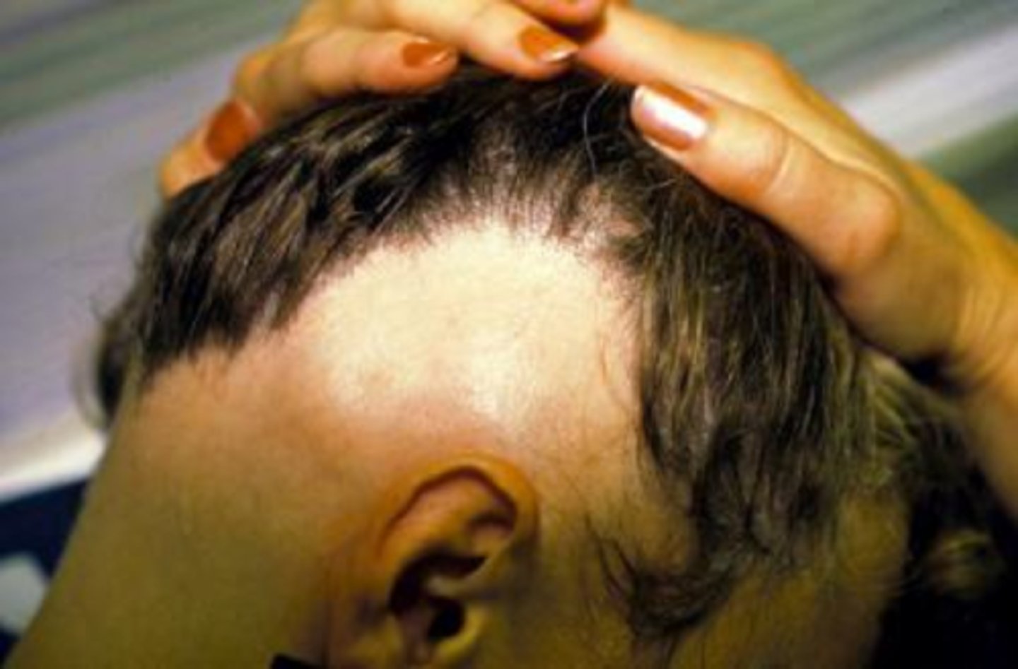 <p>Bandlike pattern of hair loss over periphery of scalp</p>