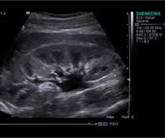 <p>Postrenal failure results from ___ obstruction and is ___ </p>