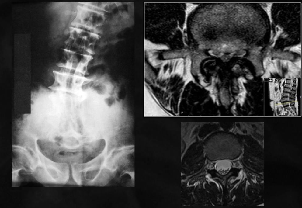 <p>what is seen here for this case of achondroplasia?</p>