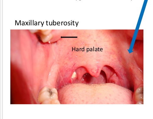 <p><span>posterior border of the maxillary alveolar ridge,<br>covered by tissue, rounded in shape</span></p>