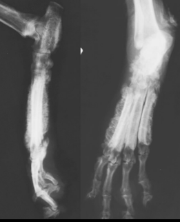 <ul><li><p><strong>Cause</strong></p><ul><li><p><strong>old </strong>dogs with<strong> lung dx</strong></p></li><li><p>Hormonal, neural, hypoxia</p></li><li><p>Begins on the abaxial surface of digit 2,5 and moves proximally</p></li></ul></li><li><p><strong>CS</strong></p><ul><li><p><strong>pulmonary</strong> dx or masses,<strong> 4 limb </strong>lameness, distal <strong>limb swelling</strong></p></li></ul></li><li><p><strong>RS</strong></p><ul><li><p>irregular periosteal reaction of tubular bones and accessory carpal/calcaneous</p></li></ul></li></ul><p></p>