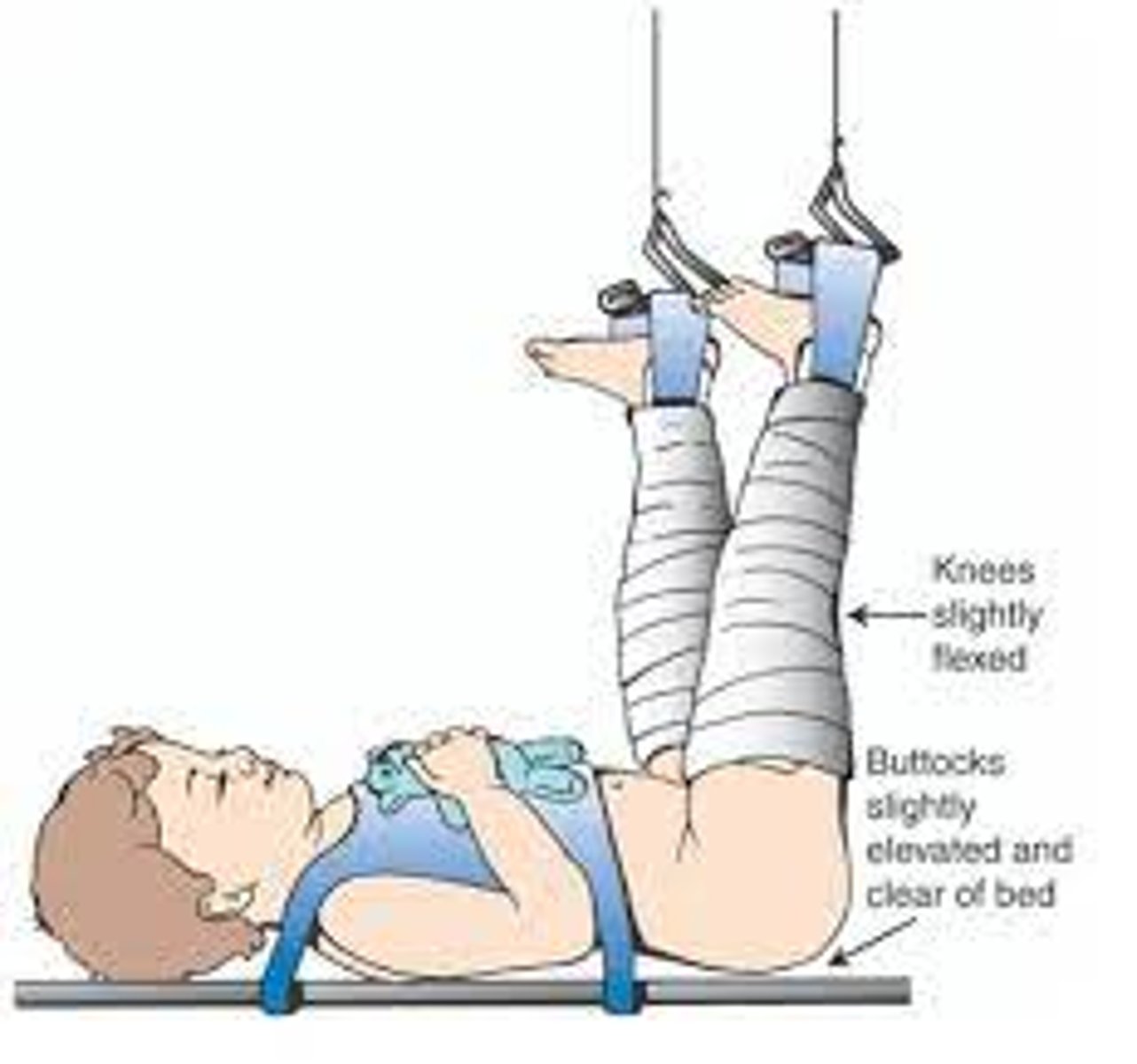 <p>Bryant traction is likely used.</p><p>-Hips are flexed at a 90-degree angle with buttocks off bed.</p><p>-Ensure the client maintains alignment.</p>