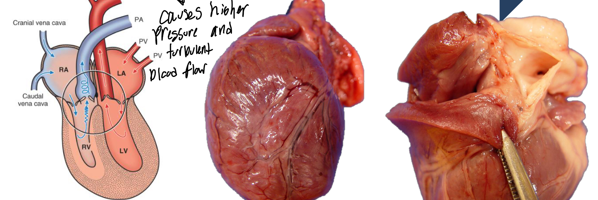 <ol><li><p>Stenotic valve restricts outflow</p></li><li><p>Pressure overload of RV</p></li><li><p>RV concentric Hypertrophy</p></li><li><p>Right Heart Failure</p></li></ol><p></p>