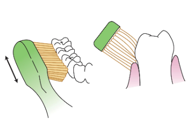 <p><span><strong>• Acceptable for all patients</strong></span></p><p><span><strong>• Periodontal Involvement</strong></span></p><p><span><strong>• Toothbrush bristles are angled apically at a 45-degree angle to the long axis of the tooth</strong></span></p><p><span><strong>• Filaments subgingival</strong></span></p><p><span><strong>• Jiggle with short horizontal strokes</strong></span></p><p><span><strong>• 2–3 teeth at a time</strong></span></p>