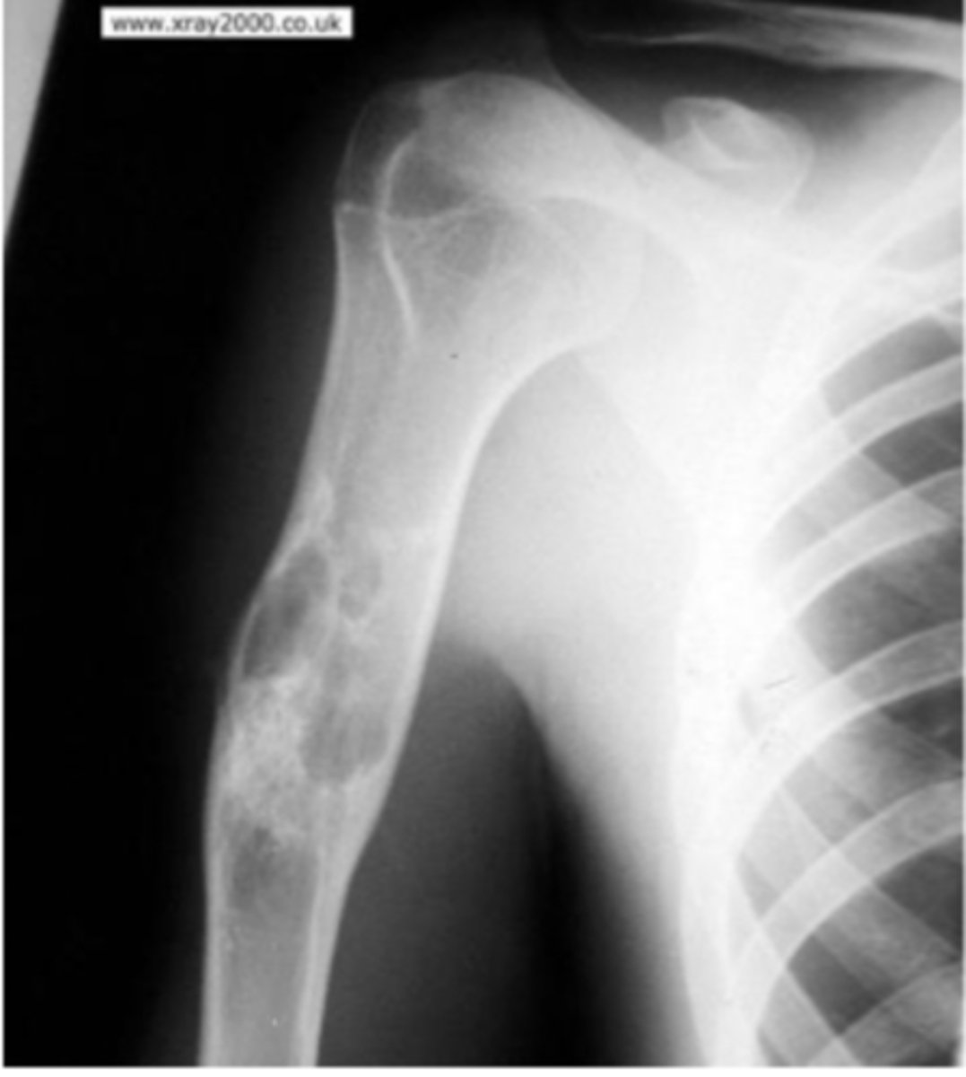 <p>The sclerotic healing is likely caused by what prior implication?</p>