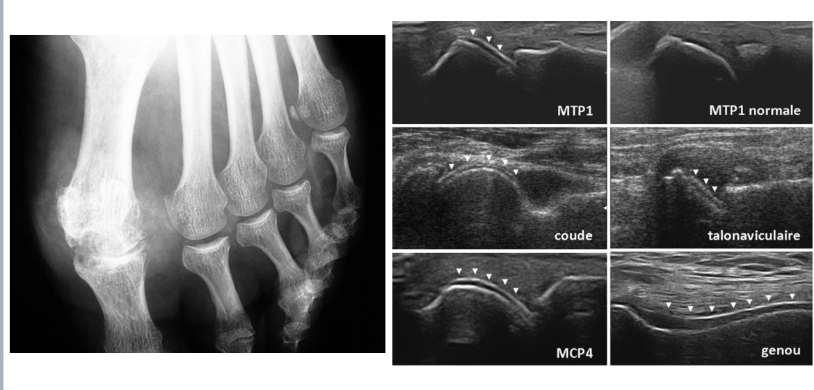 <p>= maladie de surcharge en urates, chronique, réversible </p><p>Radio : </p><ul><li><p>Arthropathie uratique chronique tardivement (géodes ou encoches épiphysaires, conservation prolongée de l’interligne articulaire et ostéophytose marginale) </p></li></ul><p>Écho articulaire :</p><ul><li><p>aspect en «&nbsp;double contour&nbsp;» : dépôt uratique surface cartilage </p></li><li><p>Tophus goutteux infra-cliniques </p></li></ul><p></p>