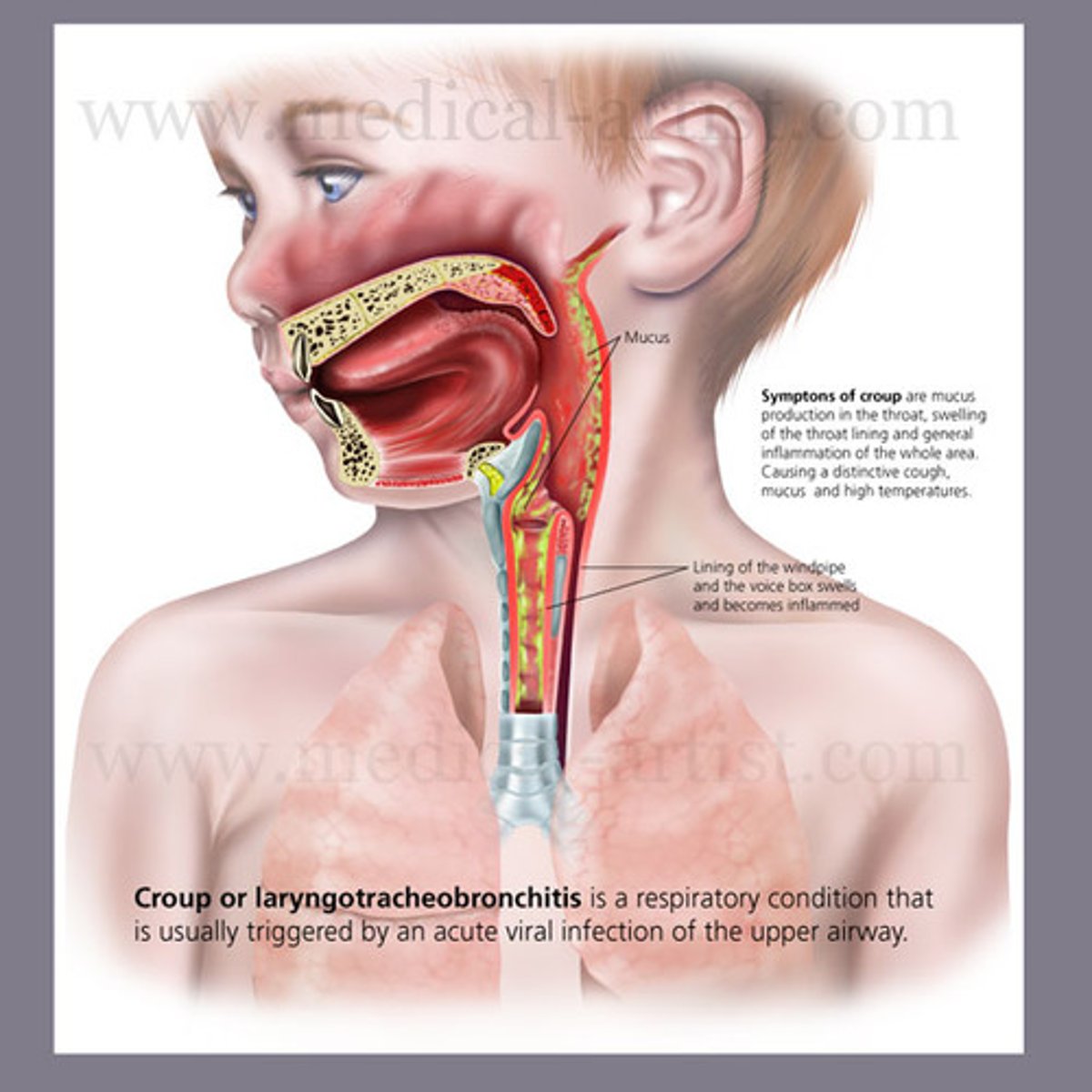 <p>Parainfluenza virus</p>