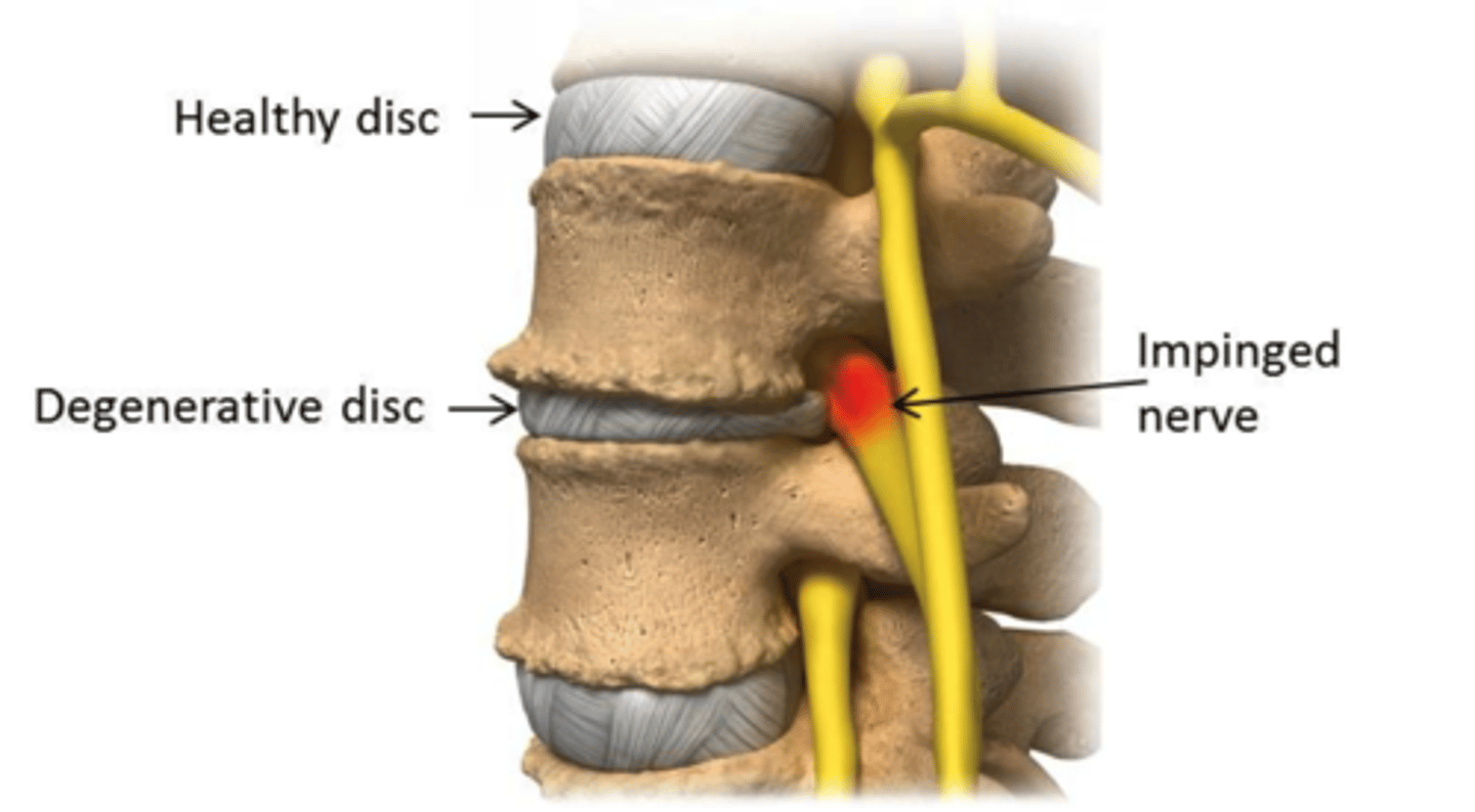 <p>mechanical pressure on a nerve that results in numbness, weakness, pins and needles</p><p>- annular walls naturally bulge over time</p><p>- space is relatively large, so an isolated disc bulge causes very little symptoms</p>