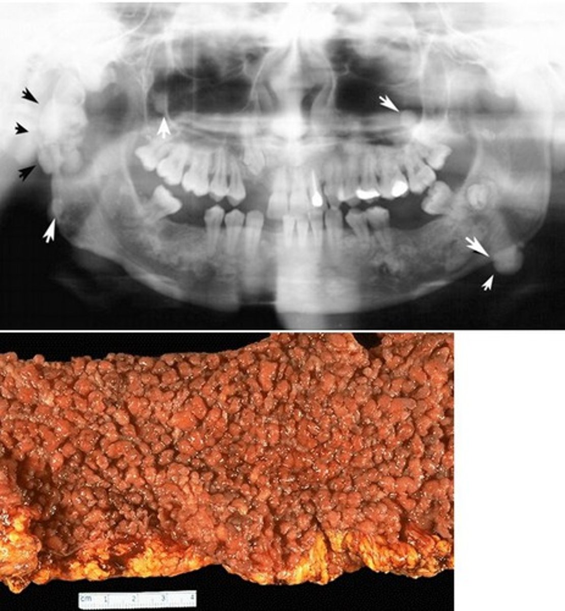 <p>Gardner syndrome</p><p>(subtype of FAP)</p>