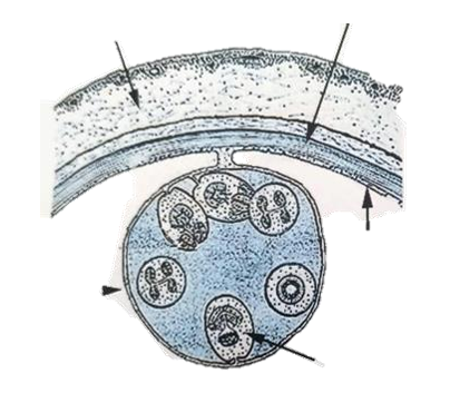 <p><strong>Echinococcus </strong>- genus of tapeworms (cestode), causing hydatid disease in humans</p><ul><li><p>Large fluid like, produces multiple infective stages (protoscolies, invaginated scolices containing suckers, hooks)</p></li><li><p><em>would maybe describe: S, rounded, 3 thick shells, embryonated, light-brown-gray</em></p></li><li><p><em>fibrous capsule of host and parasite, germinal layer, daughter cyst, hydatid cyst with protoscolex.</em></p></li></ul><p></p>