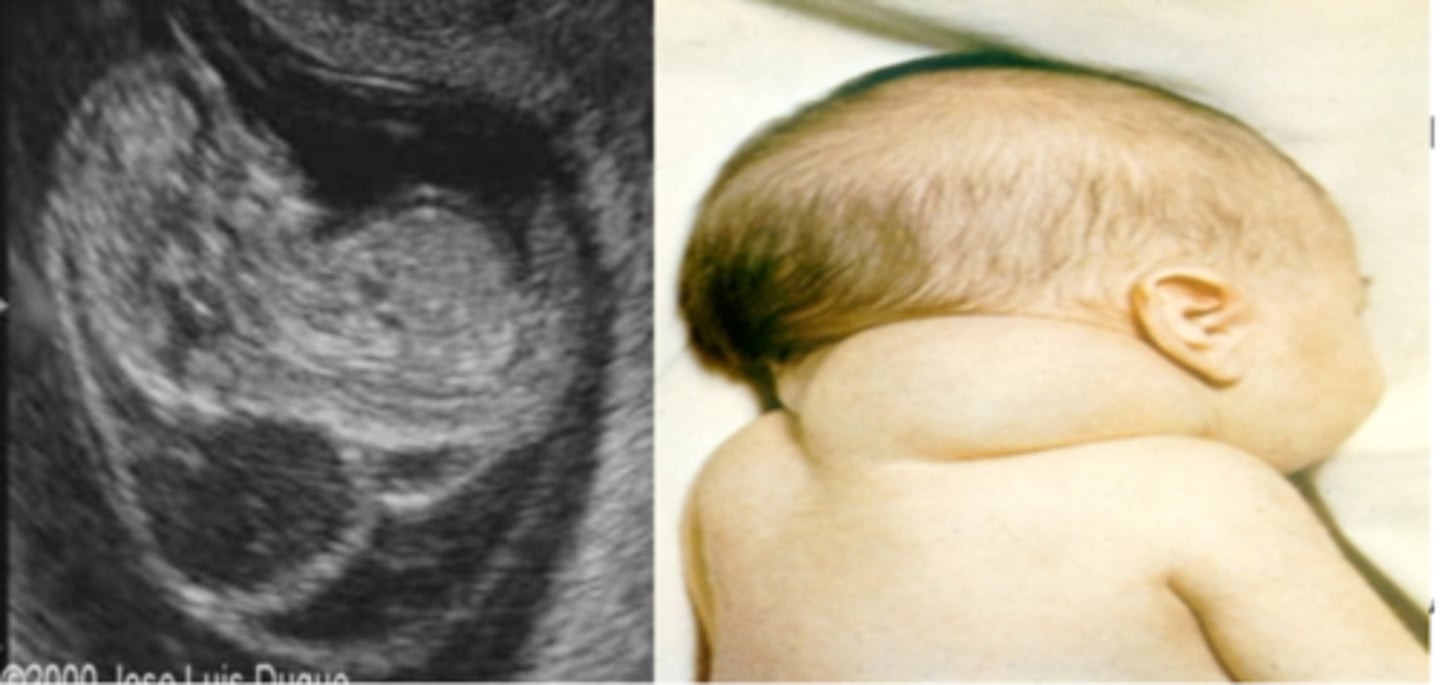 <p>Large fluid-filled swellings involving jugular lymph sacs that fail to connect to lymphatic vessels.</p>