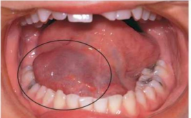 Acumulación de saliva, por obstrucción