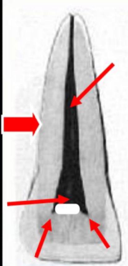 <p>mesio-distal section of pulp cavity</p>