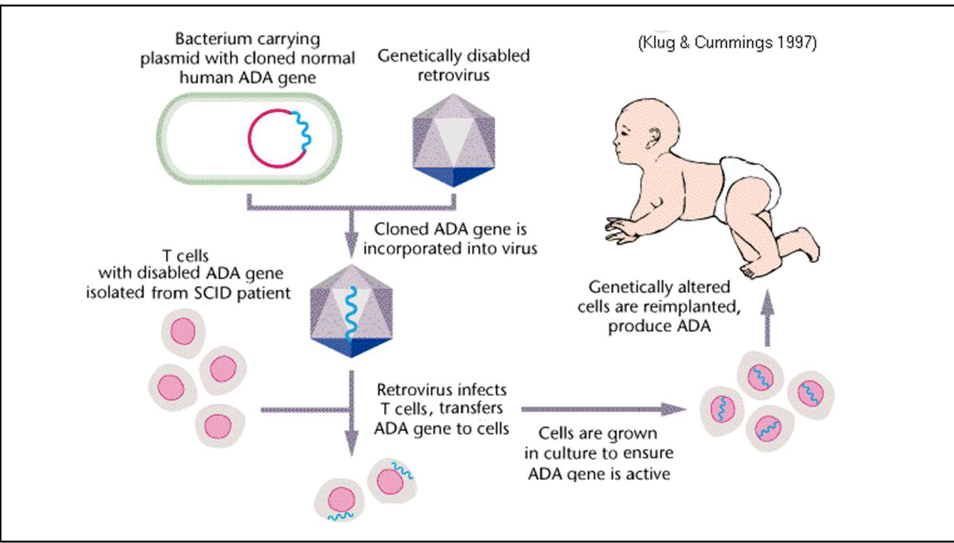 <p>Carried out at NIH in 1990</p><p>The trial aimed to treat a genetic disorder called severe combined immunodeficiency (SCID)</p><p>Specifically the form caused by a deficiency of the adenosine deaminase (ADA) enzyme. The condition is commonly known as ADA-SCID.</p><p> the initial results showed some improvement in immune function</p><p>the overall success was limited, and the treatment did not provide a complete cure.</p><p>this groundbreaking experiment marked the beginning of human gene therapy research.</p>