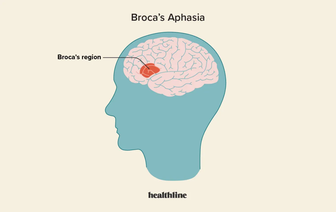 <p>a small portion of the left frontal region of the brain; this area is crucial for producing speech</p>