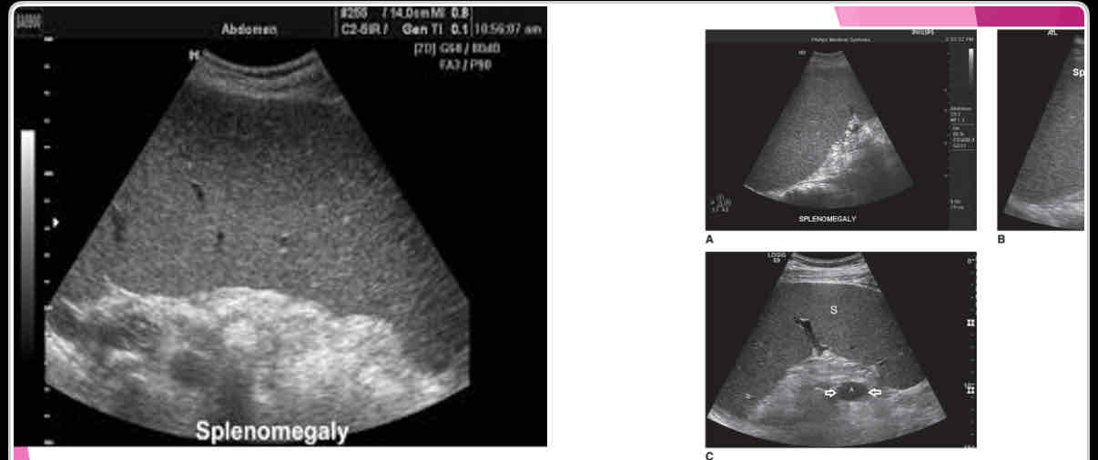 <p>With splenomegaly: when enlarges, it extends</p>