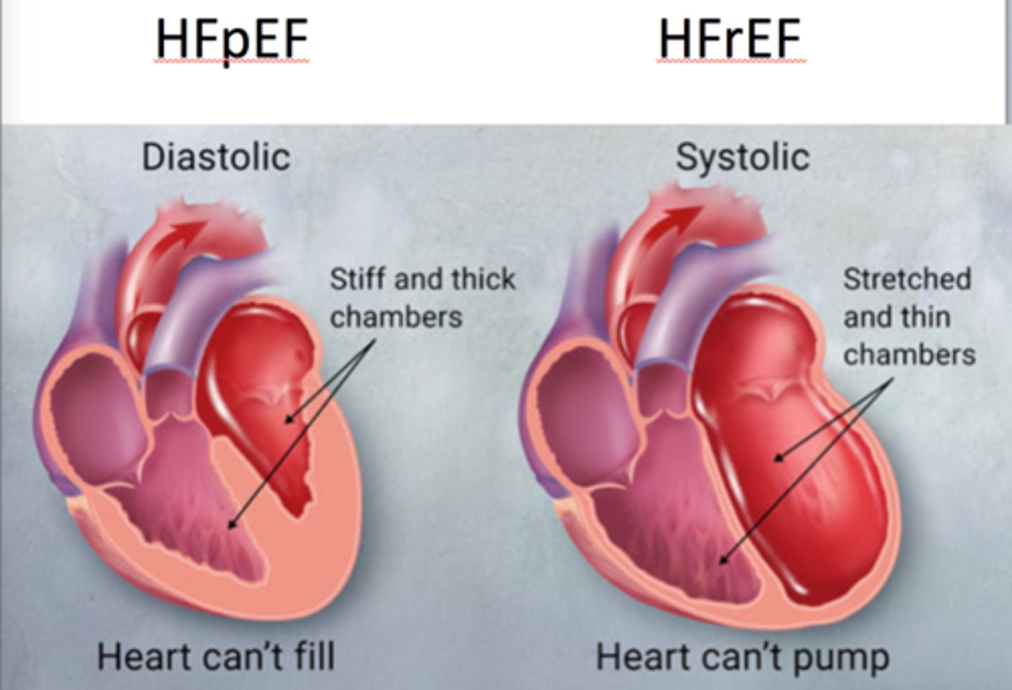<p>Ventricles are enlarged, thin, and pump less than 40-50% of EDV into circulation</p>