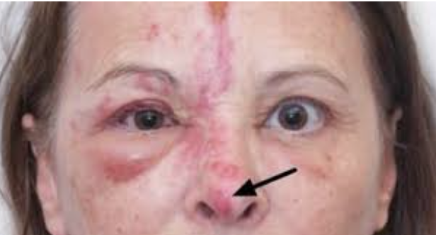<p>64 y/o patient presents to the ED for face pain that radiates to her eye. On physical exam you note a red rash following the trigeminal nerve zones. Fluorescein stain shows a corneal dendrite. What is your treatment plan?</p>