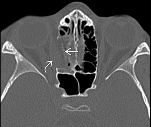 <p>inferior rectus herniating through this pathology</p>