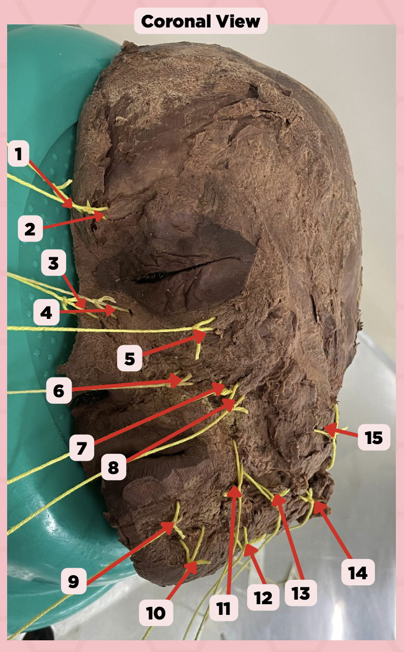 <p>What is the concluding branch of #14?</p><p>a. Premasseteric artery</p><p>b. Inferior labial artery</p><p>c. Angular artery</p><p>d. Lateral nasal artery</p>