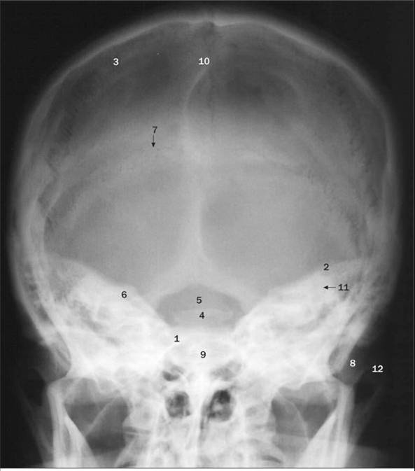 <p>Townes - What suture is demonstrated as # 7 is?</p><p>a. coronal</p><p>b.  lambdoid</p><p>c. sphenofrontal</p><p>d. sagittal</p>