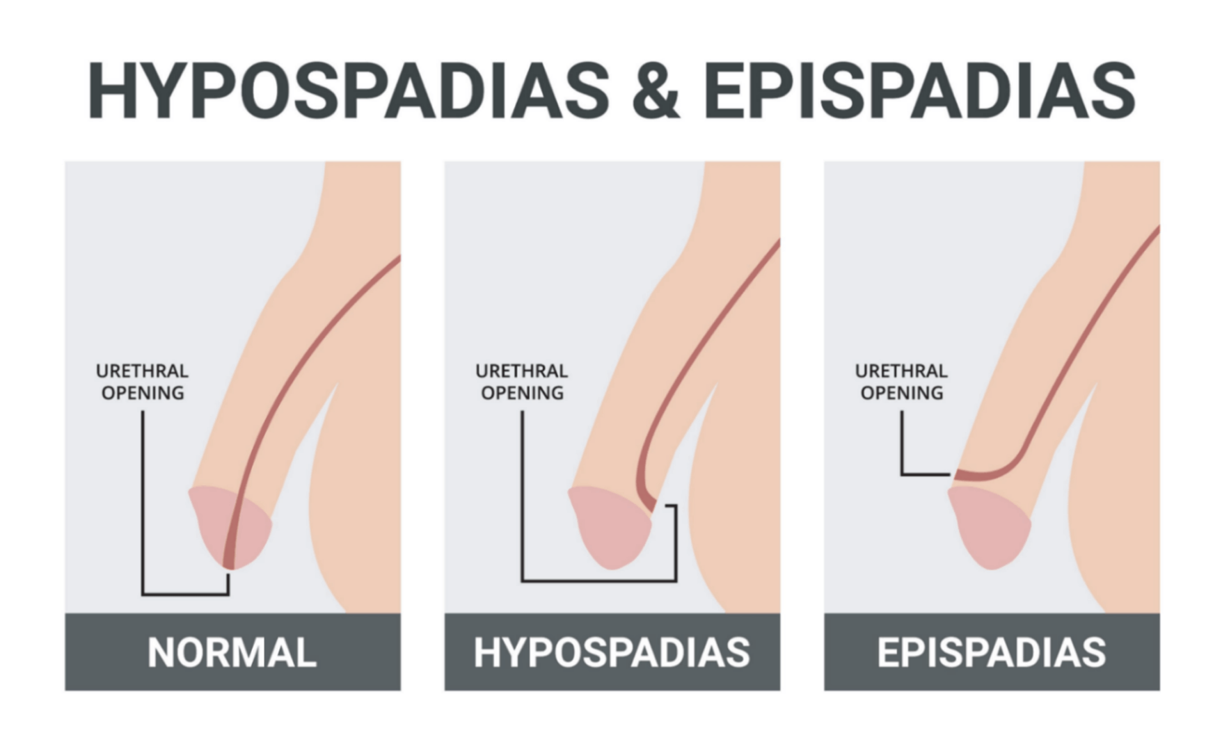 <p>Epispadias</p>