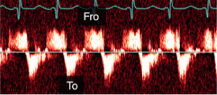 <p>What is this spectral Doppler pattern called?</p><p>Where is it found in regards to aortic dissection?</p>