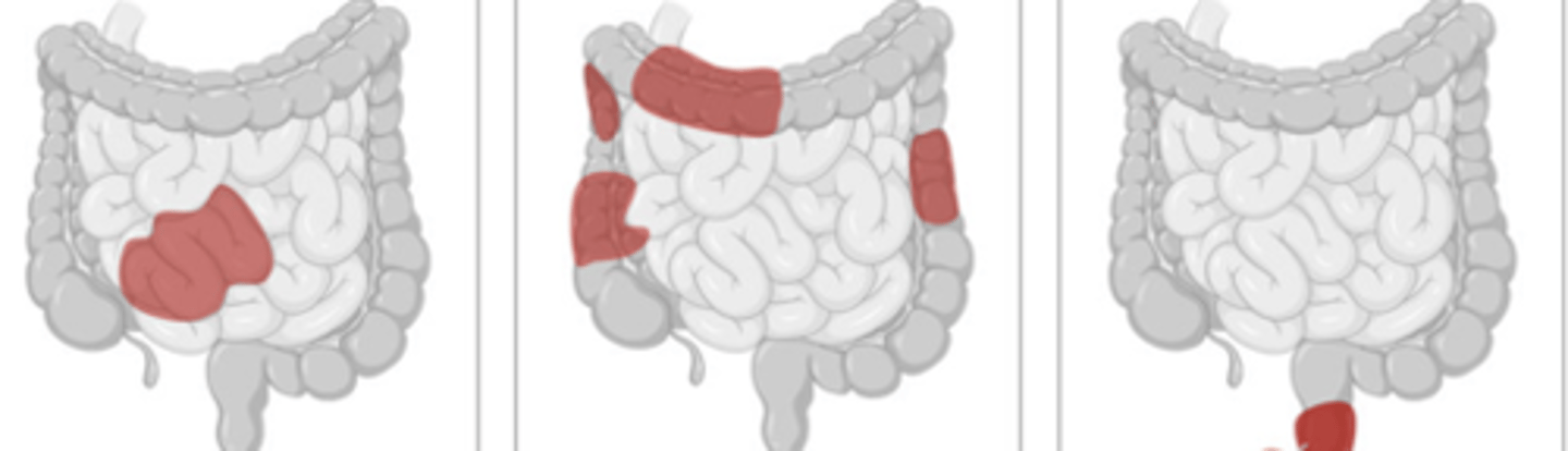 <p>UC or CD</p>