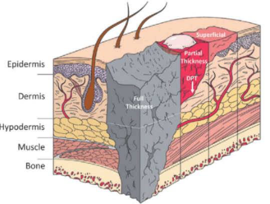 <p>extends to dermis —> hypodermis</p><ul><li><p>hemostasis</p></li><li><p>inflammatory response</p></li><li><p>proliferation</p></li><li><p>remodeling - scar tissue forms</p></li></ul><p></p>