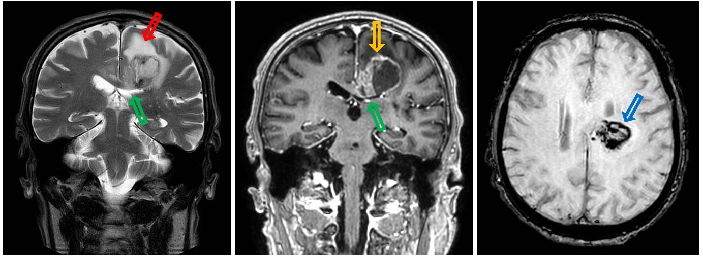 <p>Patient history: mutism (inability to speak) and right lower extremity hemiparesis with spastic muscle tone in a 79-year-old male patient</p><p>Modality: left panel – coronal view T2W MRI; middle panel – coronal view CE T1W MRI; right panel – axial view SWI MRI</p><p>Region: brain, axial and coronal views </p><p>Radiologic sign: Intraaxial left-sided parenchymal mass in the corona radiata and corpus callosum. The lesion has large perifocal edema (hyperintensity on T2W, red arrow), rim-enhancement (T1W hyperintensity, yellow arrow), and compresses the left lateral ventricle (green arrow). Intralesional hemorrhage is observable on SWI (low signal intensity, blue arrow). </p><p>Diagnosis: glioblastoma multiforme</p>