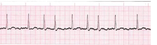 <ul><li><p>Erratic quivering or twitching of the atrial muscle caused by multiple ectopic foci in the atria that emit electrical impulses constantly </p></li><li><p>No true p waves found</p></li><li><p>Atria do not contract</p></li></ul>