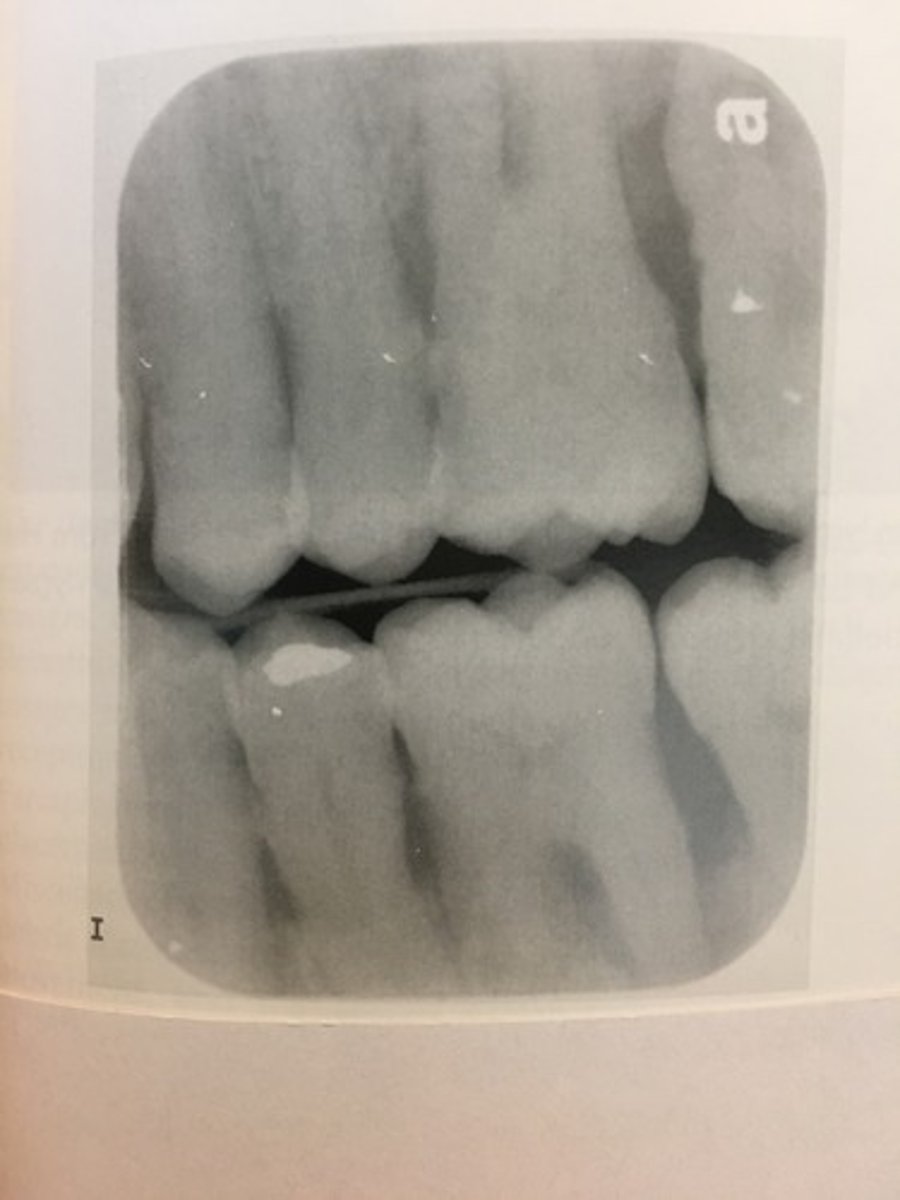 <p>Debris on the surface of the sensor may cause permanent radiopaque artifacts or radiolucent scratch marks on the sensor.</p>