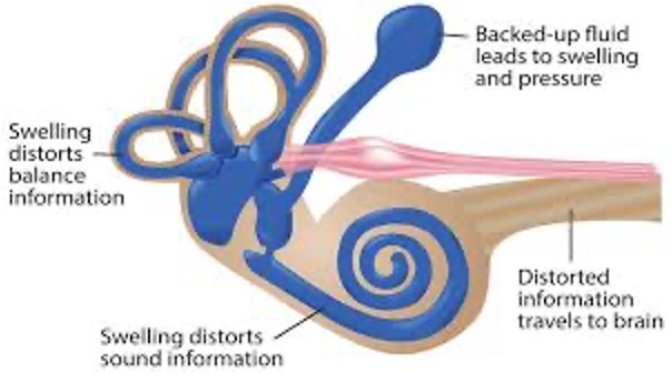 <p>tetrad: vertigo, hearing loss, tinnitus, aural pressure</p>