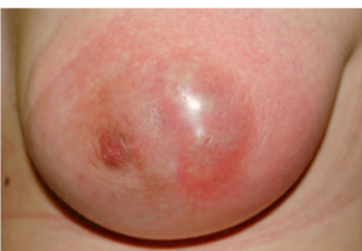 <p><strong>Breast Abscess</strong></p><p>-Localized collection of ___ within the breast tissue that is often preceded by _______</p><p>-________, tender, and palpable ____</p><p>-Treat with needle _________ and surgical ________</p><p>-May continue breastfeeding </p>