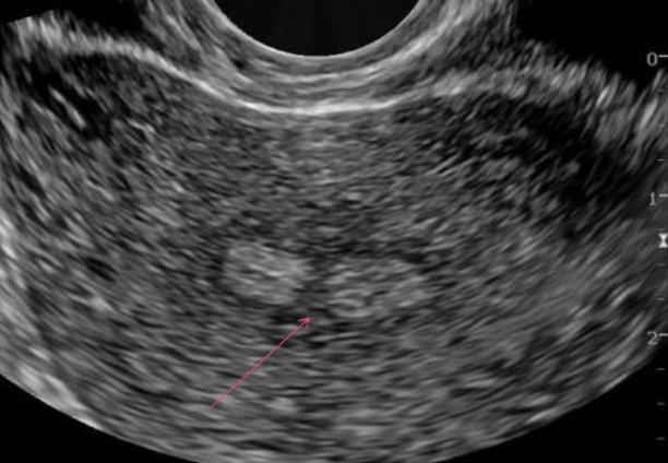 <ul><li><p>Normal appearance</p></li><li><p>Thickened endometrium</p></li></ul><p></p>