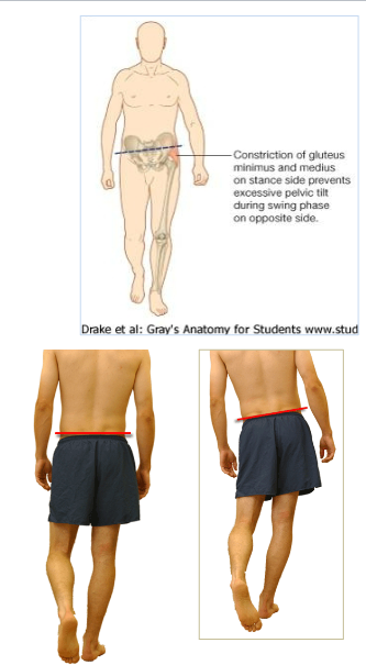 <p></p><ul><li><p><strong><em><u>Paralysis of Gluteus Medius + Minimus</u></em></strong> = (+) Trendelenburg sign</p></li><li><p>Sign: pelvis opposite the affected side drops when the affected side is supporting the body</p></li><li><p>patient will leans her trunk toward the affected side to maintain balance</p></li></ul><p></p><p></p>